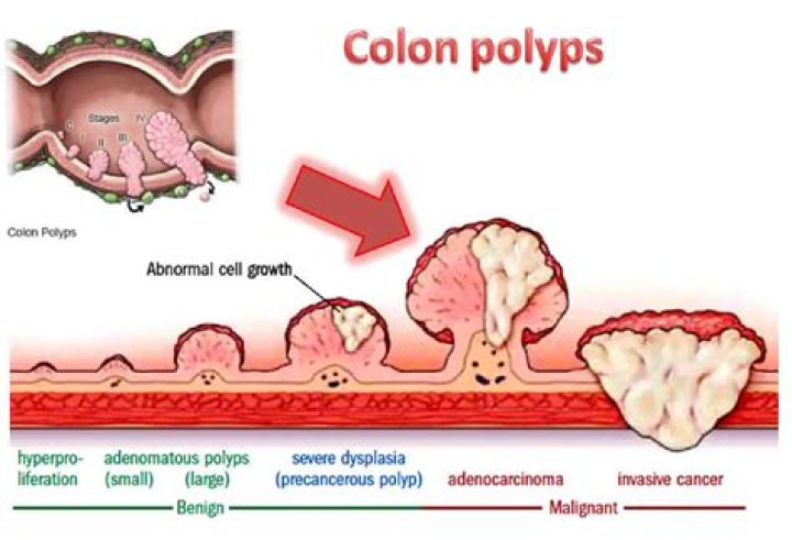 How fast does a colon polyp grow?