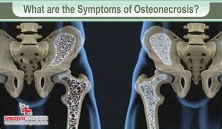 How fast does osteonecrosis progress?