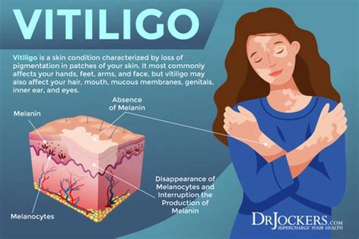 How is poliosis treated?