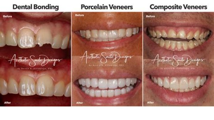 How long do veneers stay white?