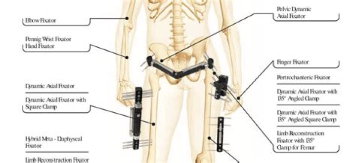 How long do you have to wear an external fixator?