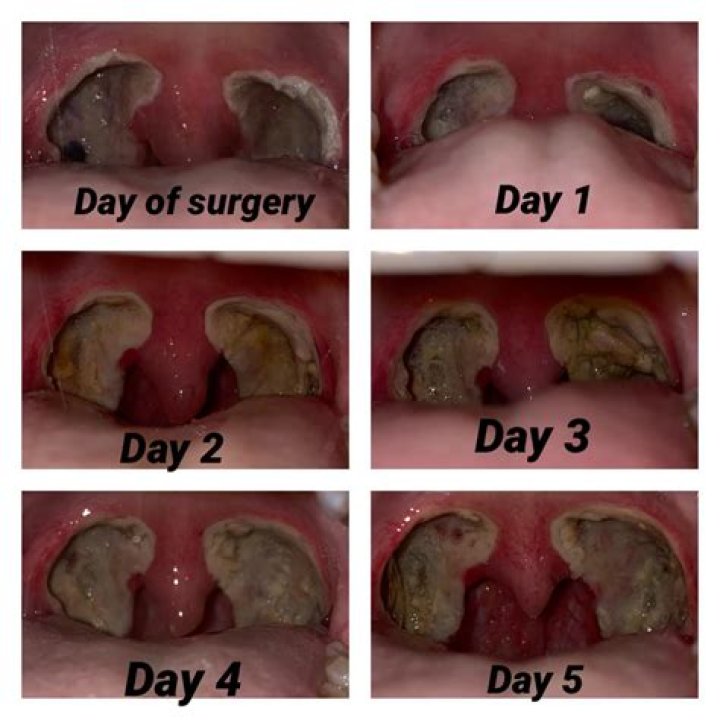 How long do you stay in hospital after tonsils removed?