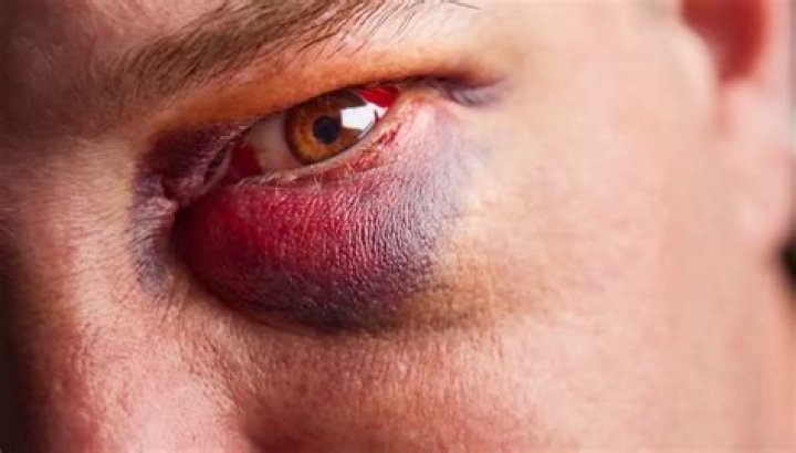 How long does a black eye last?