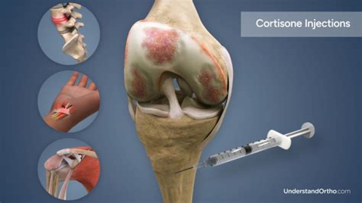 How long does a cortisone shot last in the knee?