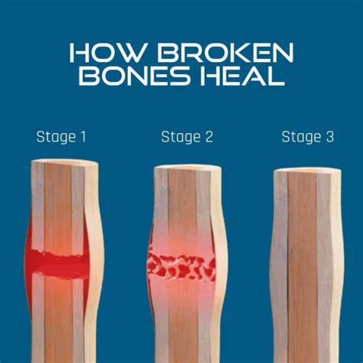 How long does a drilled bone take to heal?