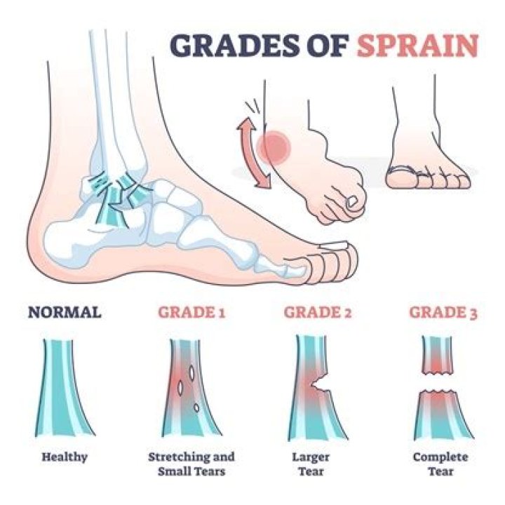 How long does a grade 2 ankle sprain take to heal?