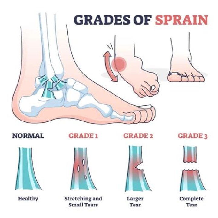 How long does a Grade 3 sprain take to heal?