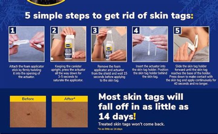 How long does a skin tag take to fall off using thread?