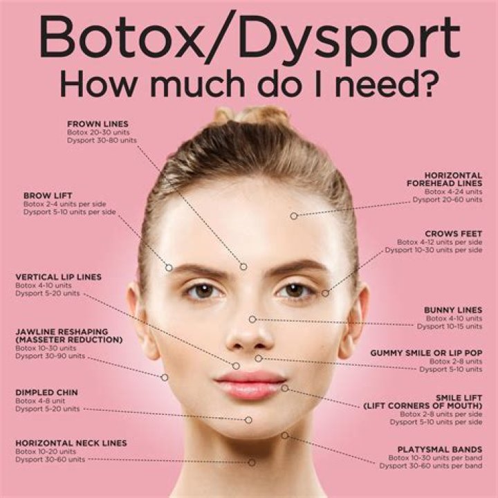 How long does Botox around mouth last?