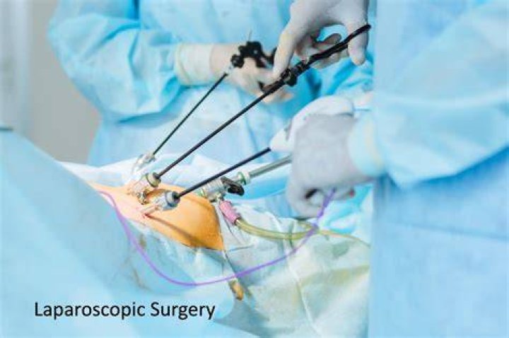 How long does gas from laparoscopic surgery last?