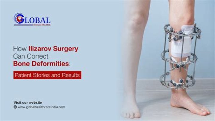 How long does Ilizarov surgery take?