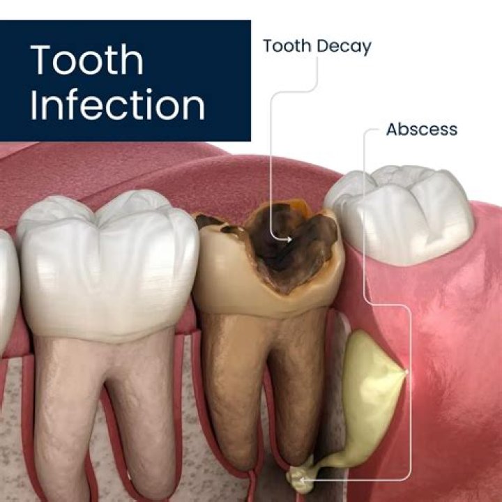 How long does it take an infection to heal with antibiotics?