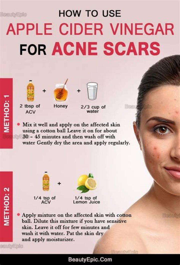 How long does it take for apple cider vinegar to clear skin?