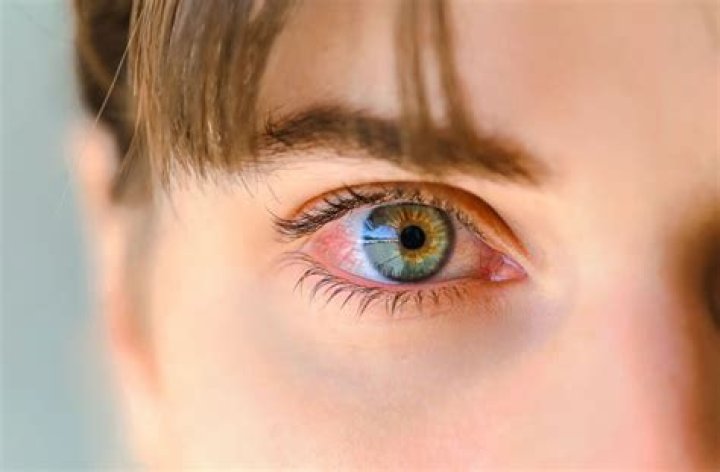 How long does it take for pinkeye to clear up?