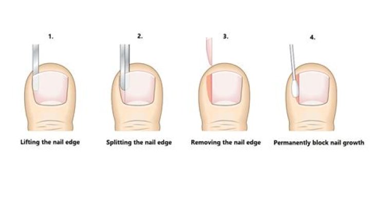 How long does it take to recover from toenail removal?