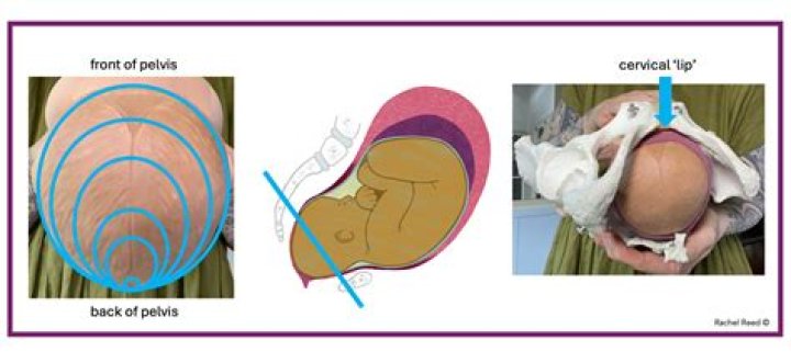 How many cm dilated is too late for an epidural?