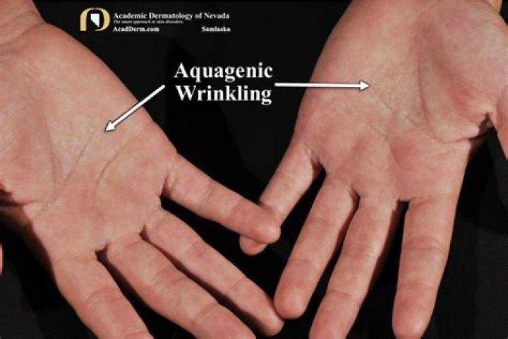How many people in the world have aquagenic wrinkling of the palms?