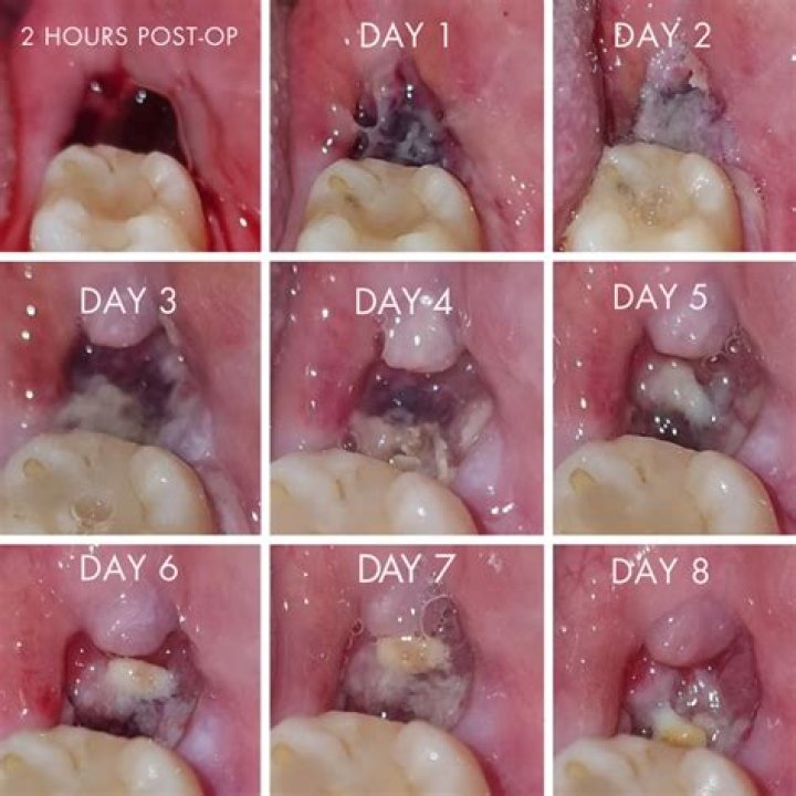 How many teeth can be extracted at the same time?