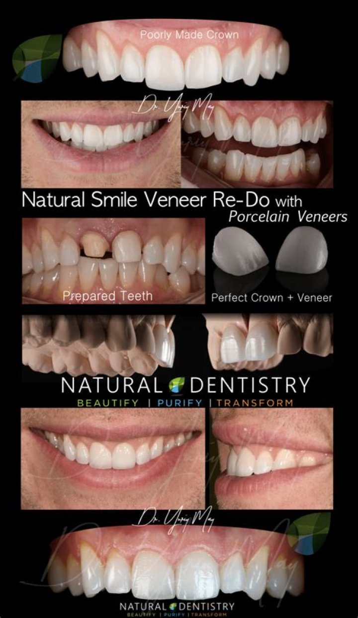 How many times can you redo veneers?