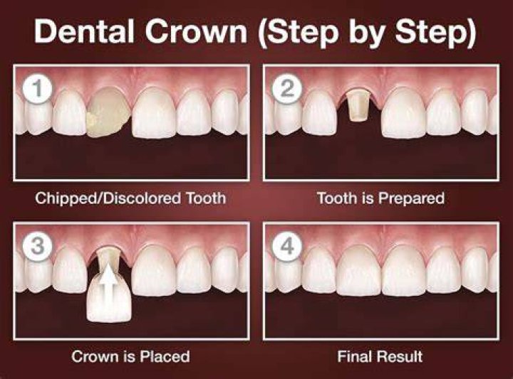 How much of a tooth is needed for a crown?