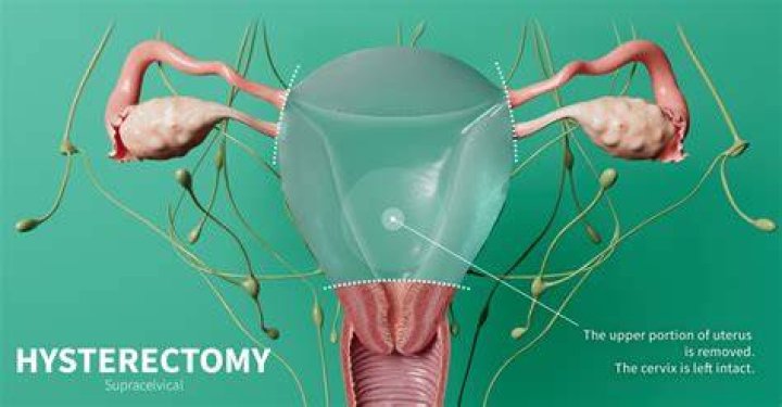 How much pain is there after a robotic hysterectomy?