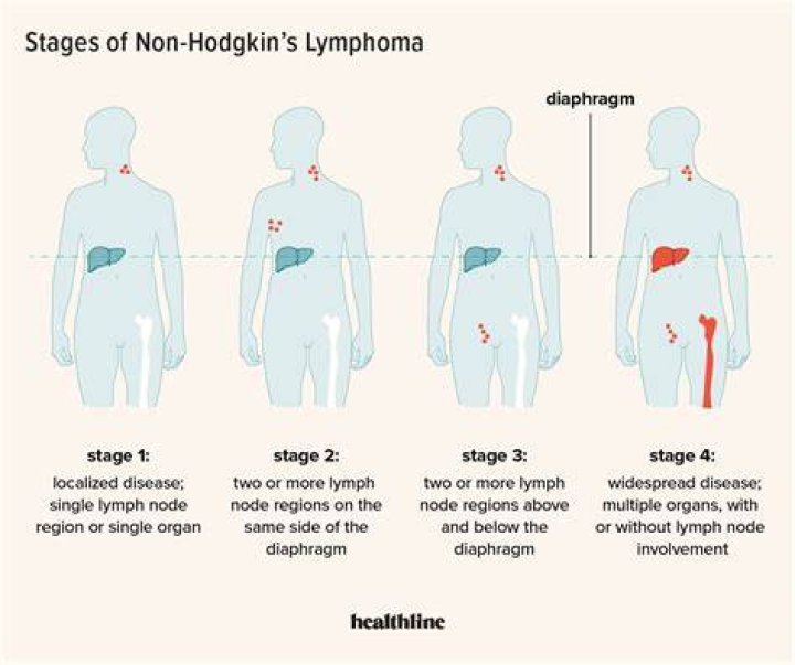 How serious is non-Hodgkin's lymphoma?