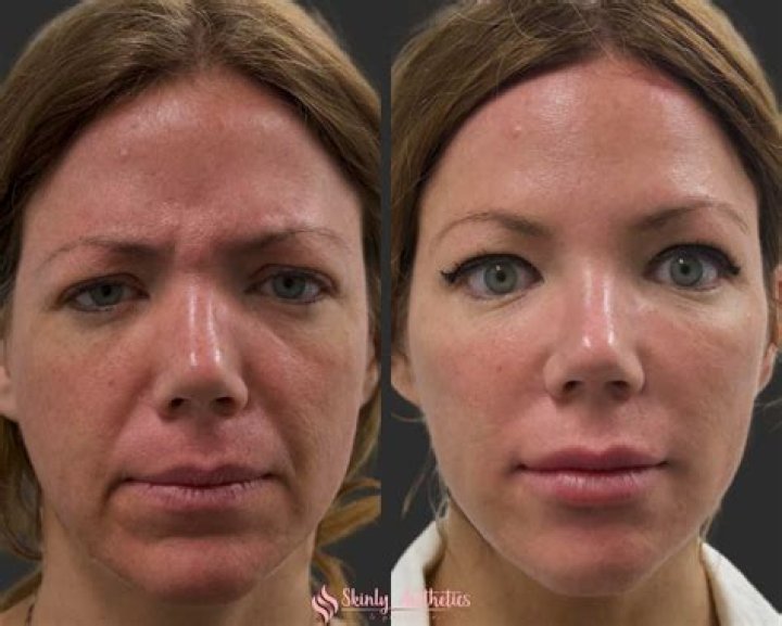 Is 70 too old for facial fillers?
