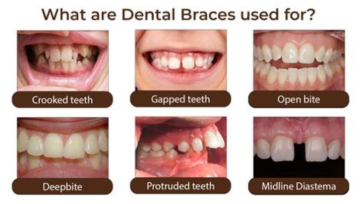 Is 70 too old to get braces?