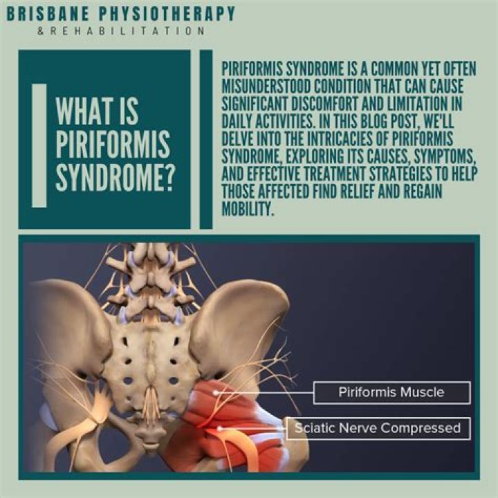 Is a hot bath good for piriformis syndrome?