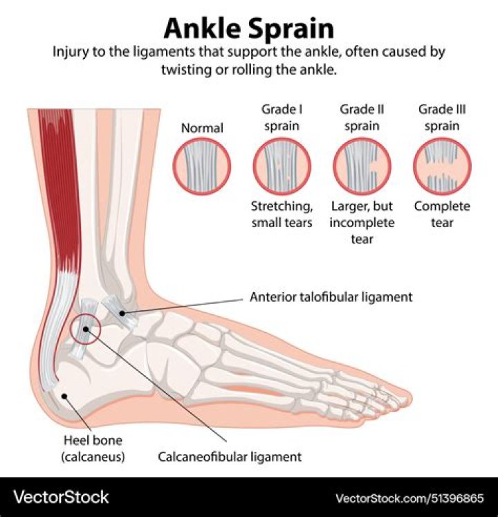 Is a sprain worse than a break?
