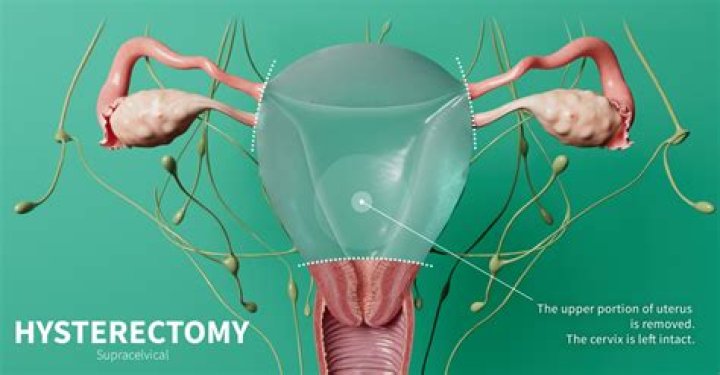 Is a total hysterectomy considered major surgery?