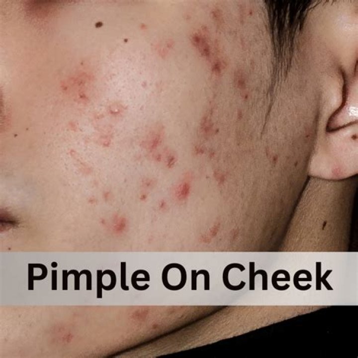 Is heat or cold better for pimples?