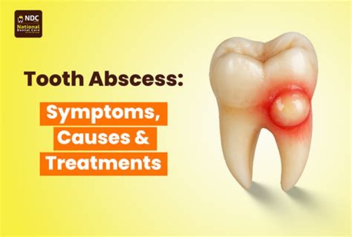 Is it good if a tooth abscess bursts?