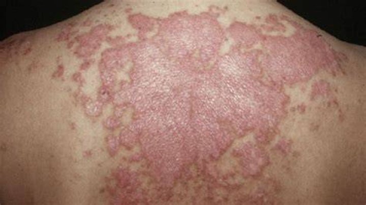 Is it hard to walk with lupus?