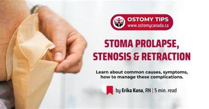 Is living with a stoma difficult?