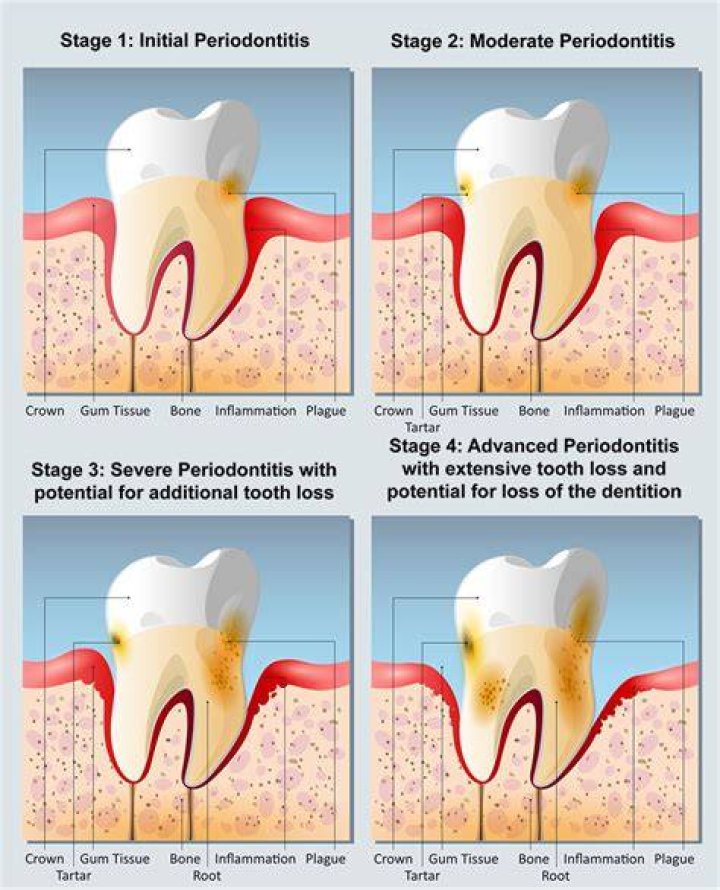 Is periodontitis Stage 1 reversible?