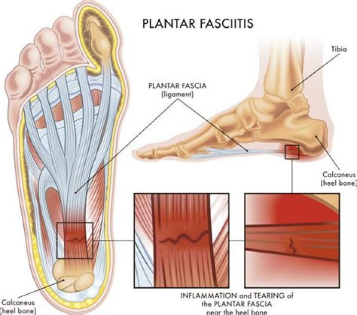 Is plantar fasciitis caused by being overweight?