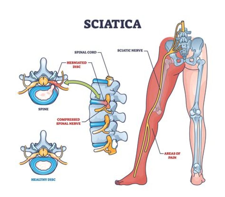 Is sciatica a serious condition?