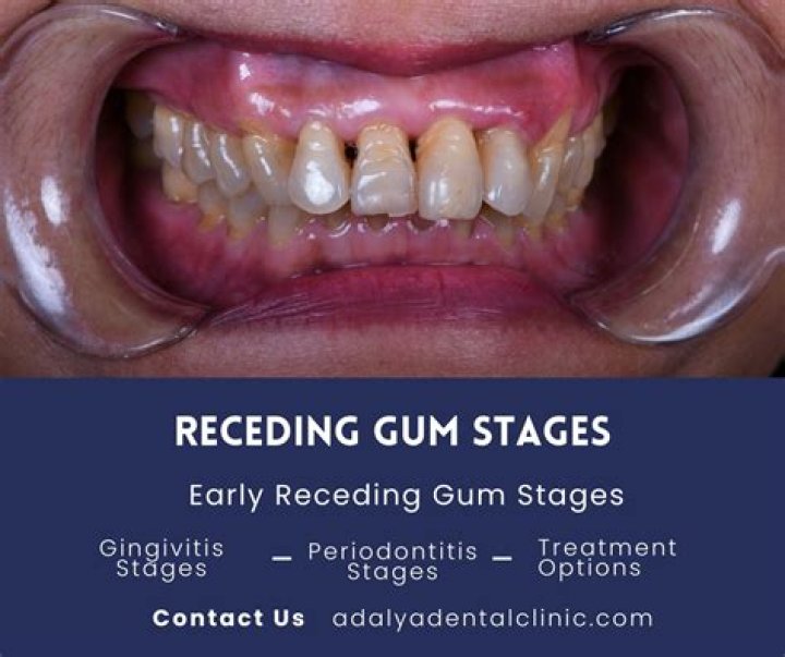 Is tea good for gums?