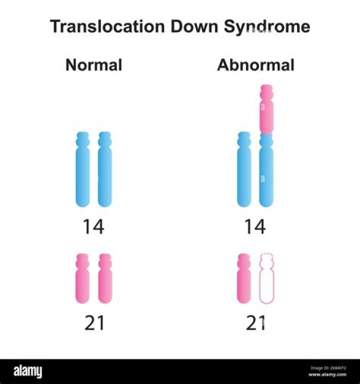 Is there a cure coming soon for Down syndrome?