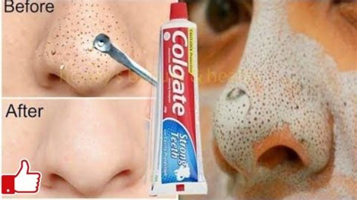 Is toothpaste good for blackheads?