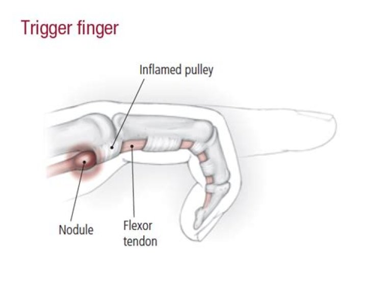 Is trigger finger a form of arthritis?