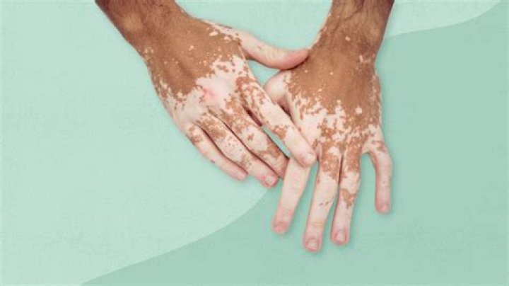Is vitiligo caused by the sun?