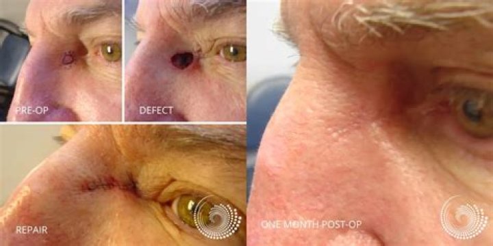 Is walking OK after Mohs surgery?