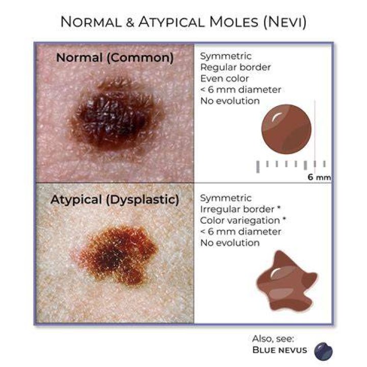 Should I pop a mole?