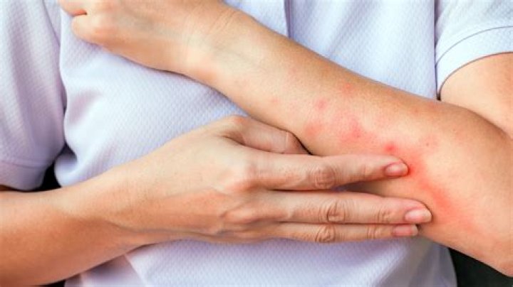 Should I scratch mosquito bites?
