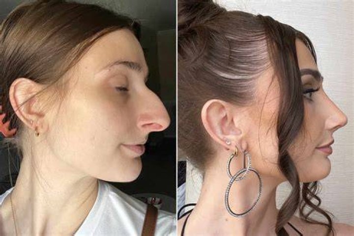 Should I tell my boyfriend I had a nose job?