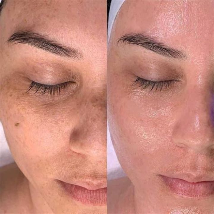 Should I wash my face the night after a Hydrafacial?
