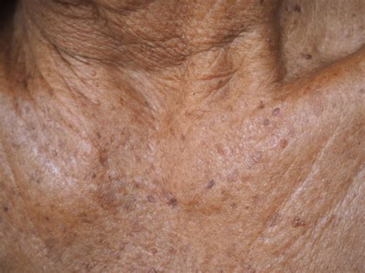 Should I worry about actinic keratosis?