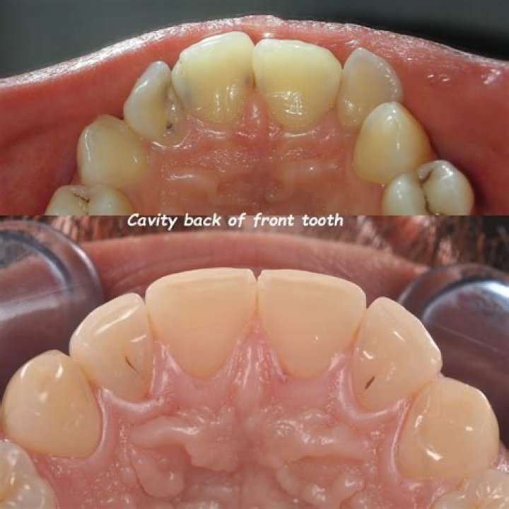 Should my top teeth touch my bottom braces?